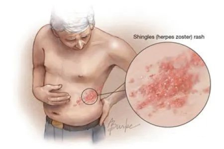 帶狀皰疹的發病機制是怎樣的？