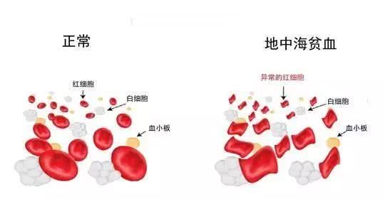 地中海貧血有什麼危害？