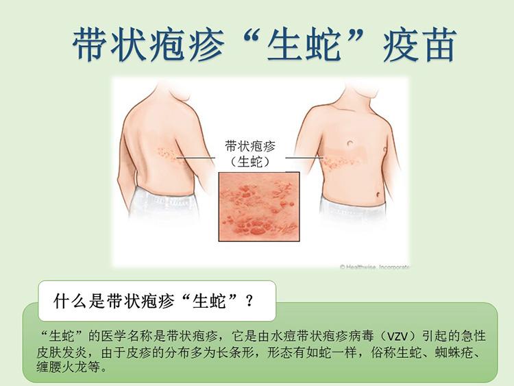 生蛇當作皮膚過敏醫治？預防生蛇最有效的方法——生蛇疫苗