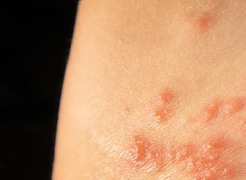 聽說帶狀皰疹有自限性，那還需要預防嗎？
