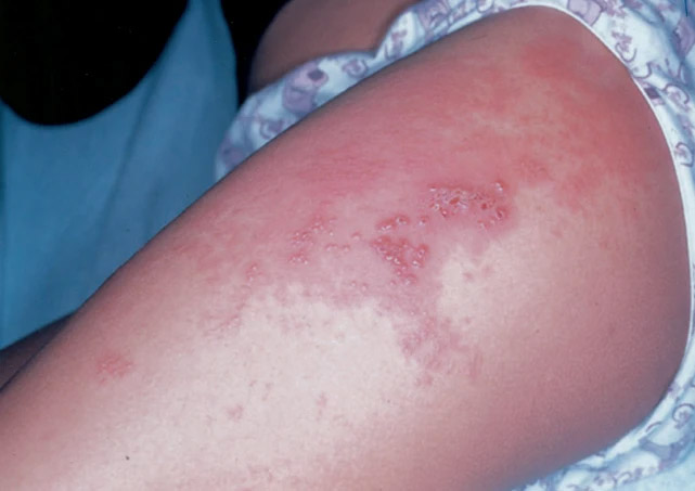 兒童也會發生帶狀皰疹？