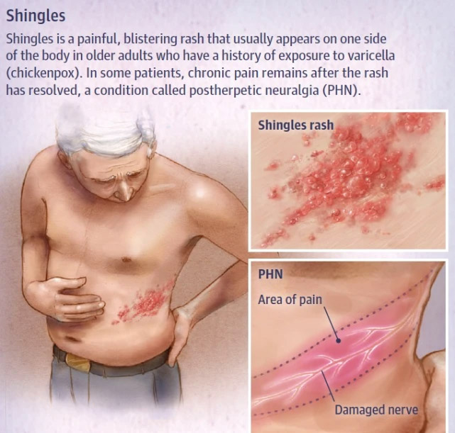 50歲以下人群如何預防帶狀皰疹？