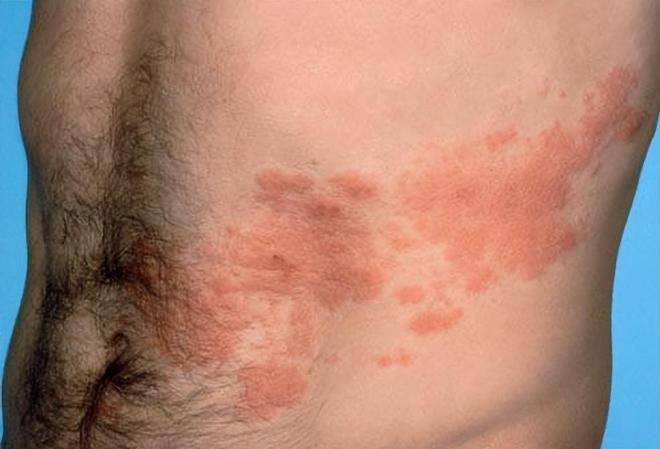 沒出過水痘為什麼也會有帶狀皰疹？超過90%成人都有這種病毒！