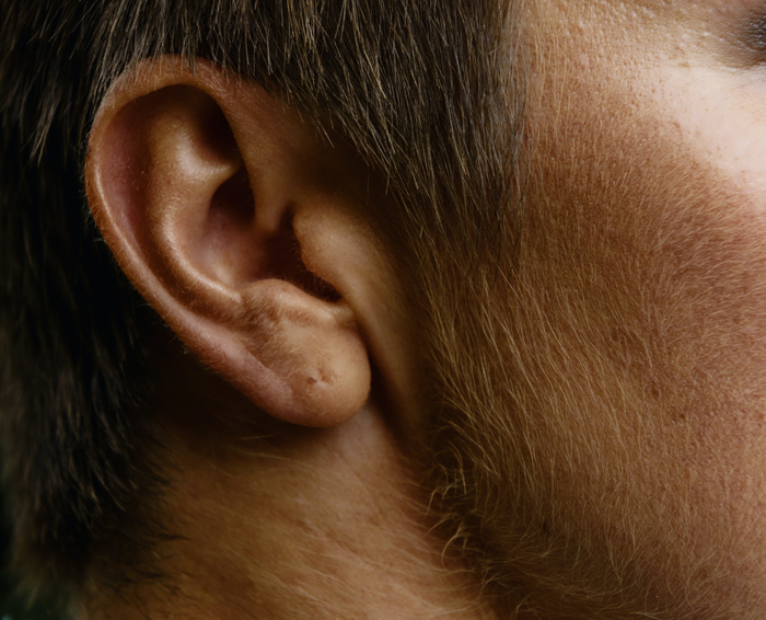 什麼是耳部帶狀皰疹?