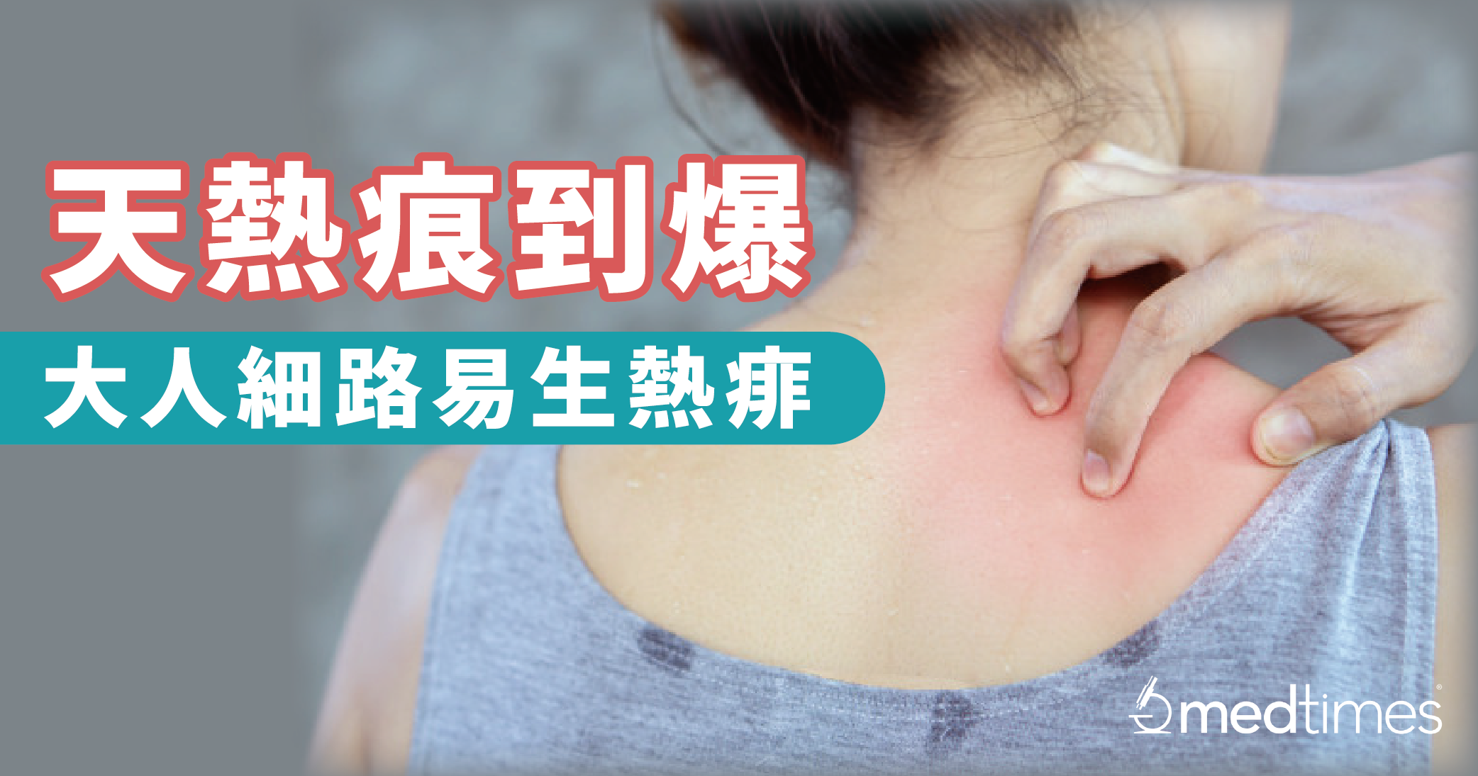 【夏季健康】天熱痕到爆 大人細路易生熱痱